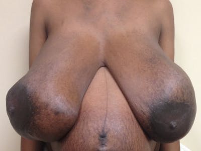Breast Reconstruction Before & After Gallery - Patient 268630 - Image 1