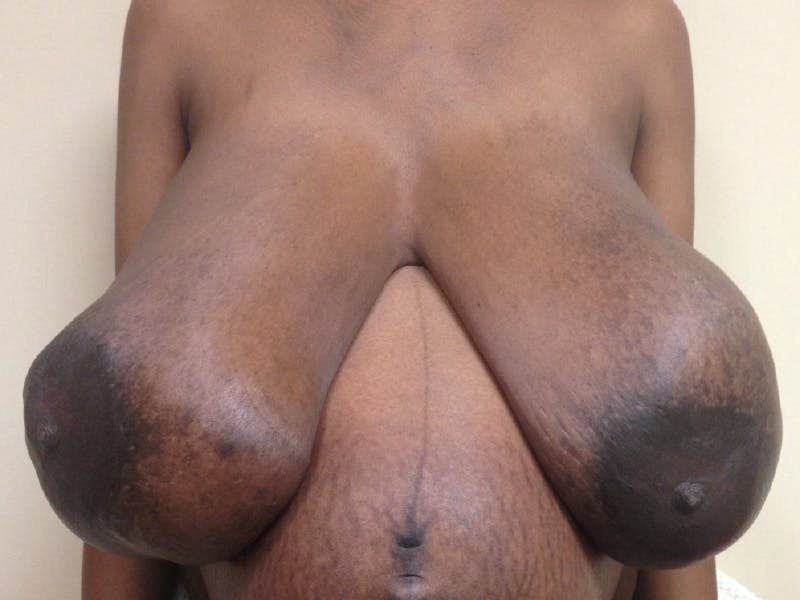 Breast Reconstruction Before & After Gallery - Patient 268630 - Image 1