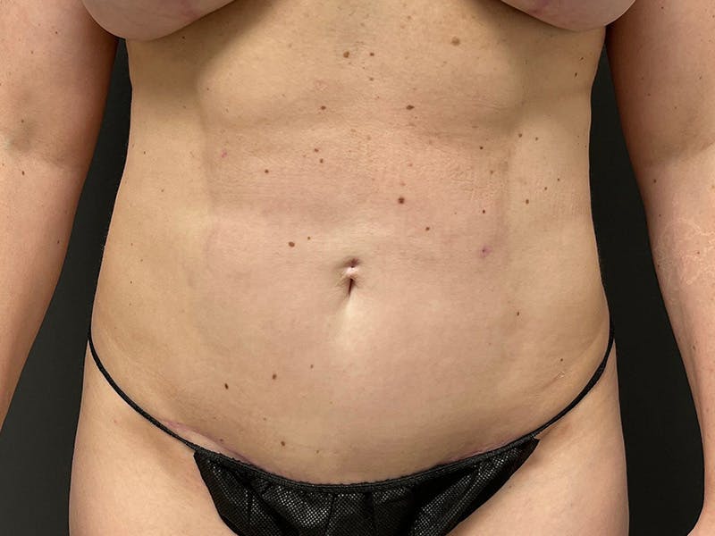 Mini Tummy Tuck Before & After Gallery - Patient 169656 - Image 2