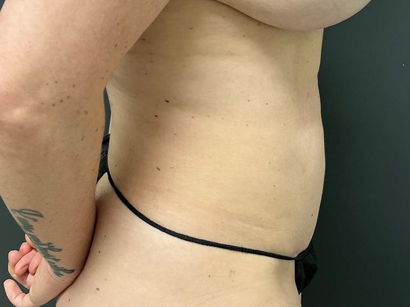 Abdomen Before & After Gallery - Patient 419008 - Image 6