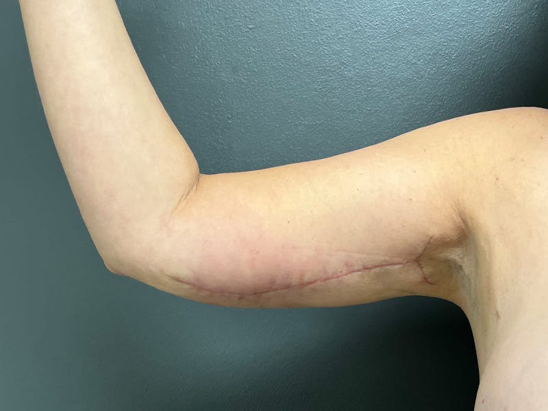 Arm Lift Before & After Gallery - Patient 460783 - Image 4
