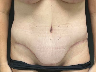 Abdomen Before & After Gallery - Patient 924975 - Image 2