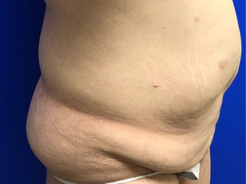 Tummy Tuck Before & After Gallery - Patient 308747 - Image 3