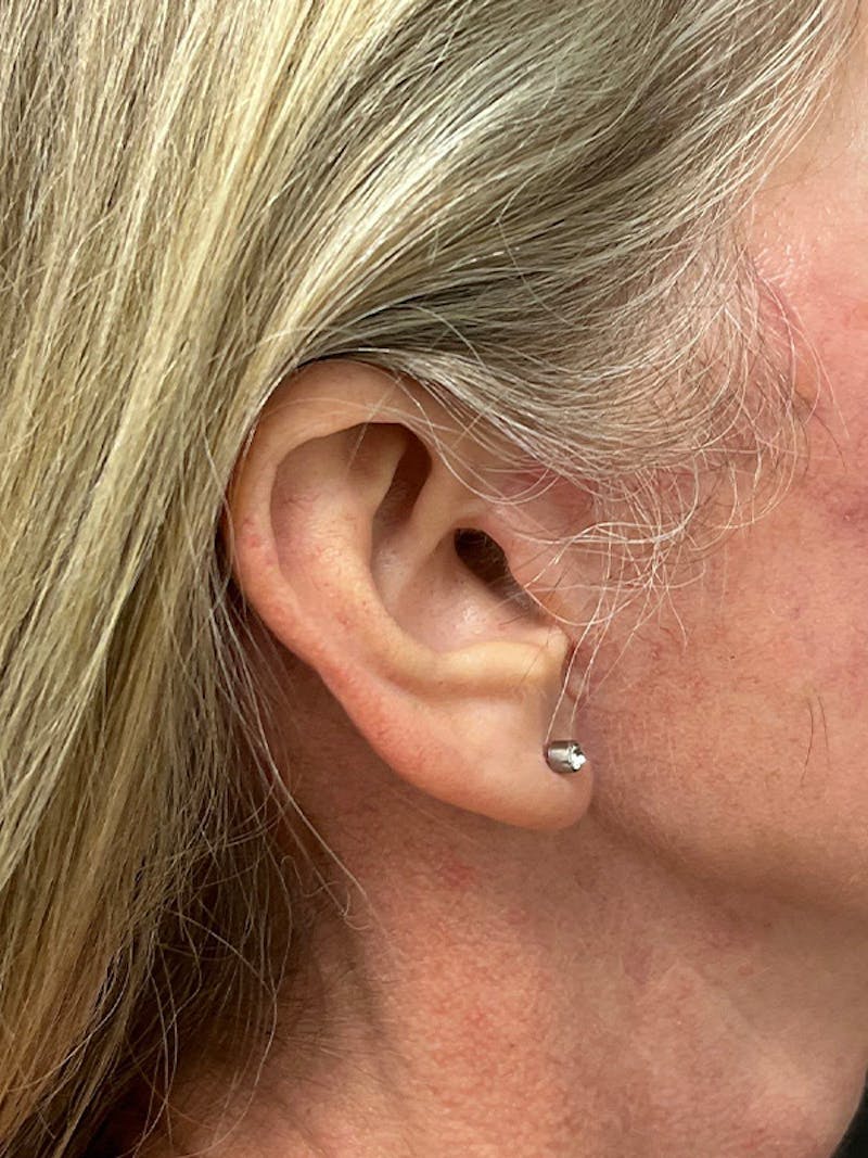 Earlobe Repair Before & After Gallery - Patient 298992 - Image 2