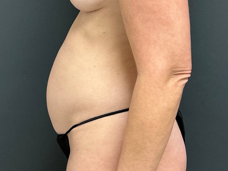 Tummy Tuck Before & After Gallery - Patient 289695 - Image 9