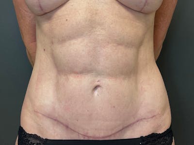 Abdomen Before & After Gallery - Patient 357328 - Image 2