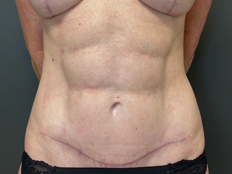 Abdomen Before & After Gallery - Patient 357328 - Image 2