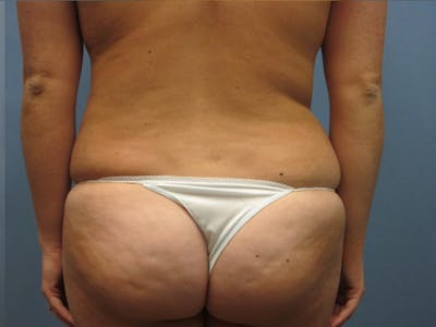 Abdomen Before & After Gallery - Patient 254696 - Image 2