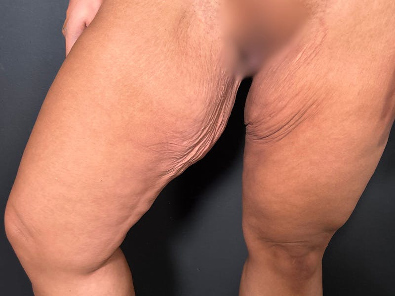 Thigh Lift Before & After Gallery - Patient 128992 - Image 5