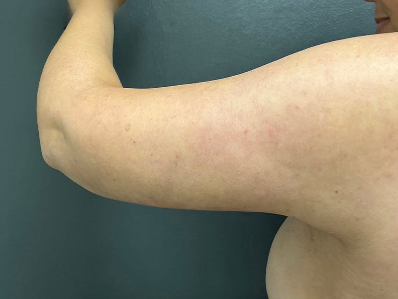 Arm Lift Before & After Gallery - Patient 460783 - Image 8