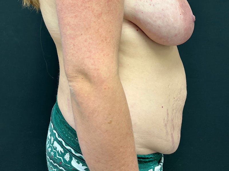 Tummy Tuck Before & After Gallery - Patient 187996 - Image 5