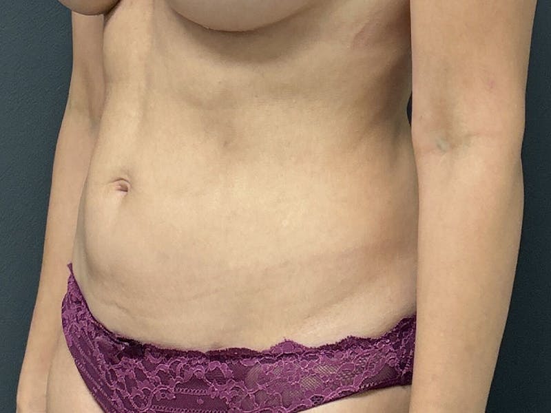 Abdomen Before & After Gallery - Patient 171479 - Image 8