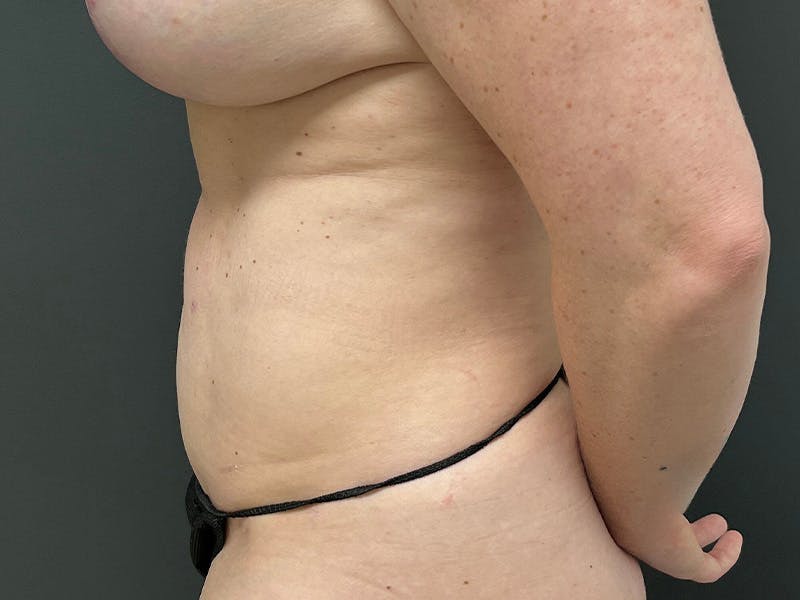 Mini Tummy Tuck Before & After Gallery - Patient 169656 - Image 10