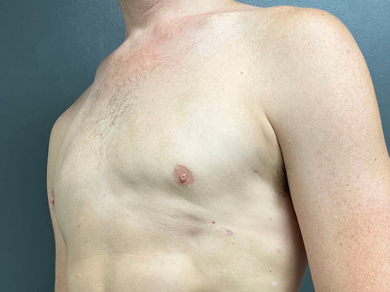Gynecomastia Before & After Gallery - Patient 376405 - Image 8