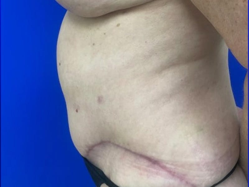 Tummy Tuck Before & After Gallery - Patient 548883 - Image 6