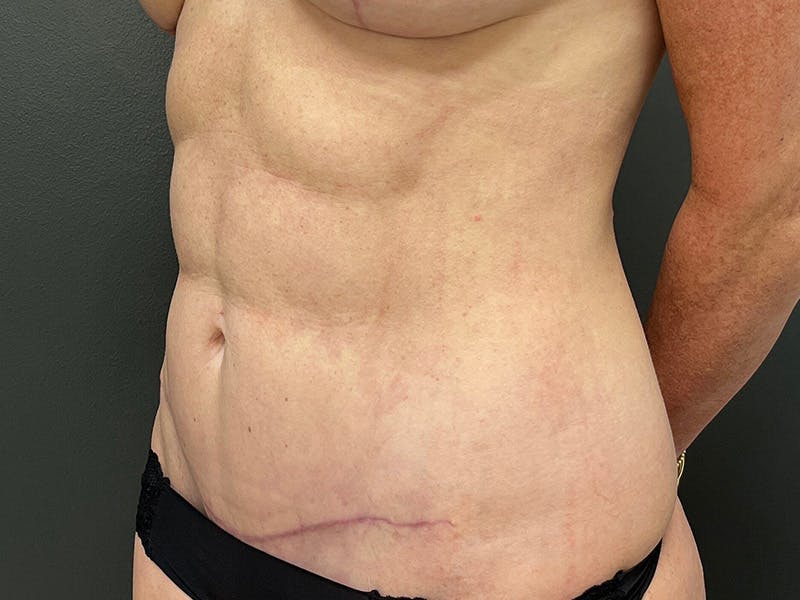 Abdomen Before & After Gallery - Patient 357328 - Image 8