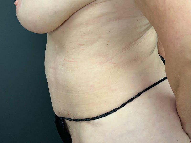 Abdomen Before & After Gallery - Patient 784997 - Image 10