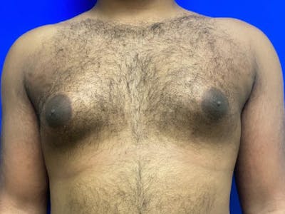 Gynecomastia Before & After Gallery - Patient 265666 - Image 1