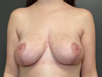 Mastopexy (Breast Lift) Before & After Gallery - Patient 113118 - Image 2