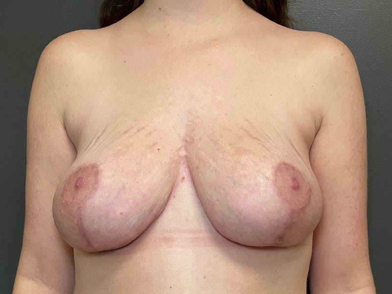 Mastopexy (Breast Lift) Before & After Gallery - Patient 113118 - Image 2
