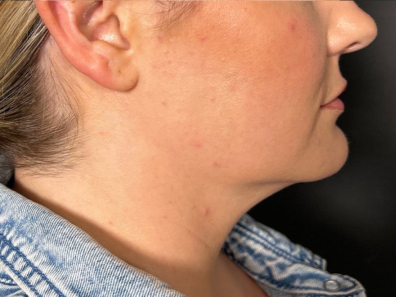 Submental Before & After Gallery - Patient 252708 - Image 1
