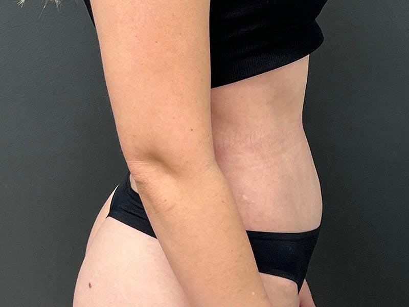 Tummy Tuck Before & After Gallery - Patient 266737 - Image 5