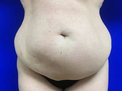 Tummy Tuck Before & After Gallery - Patient 404858 - Image 1