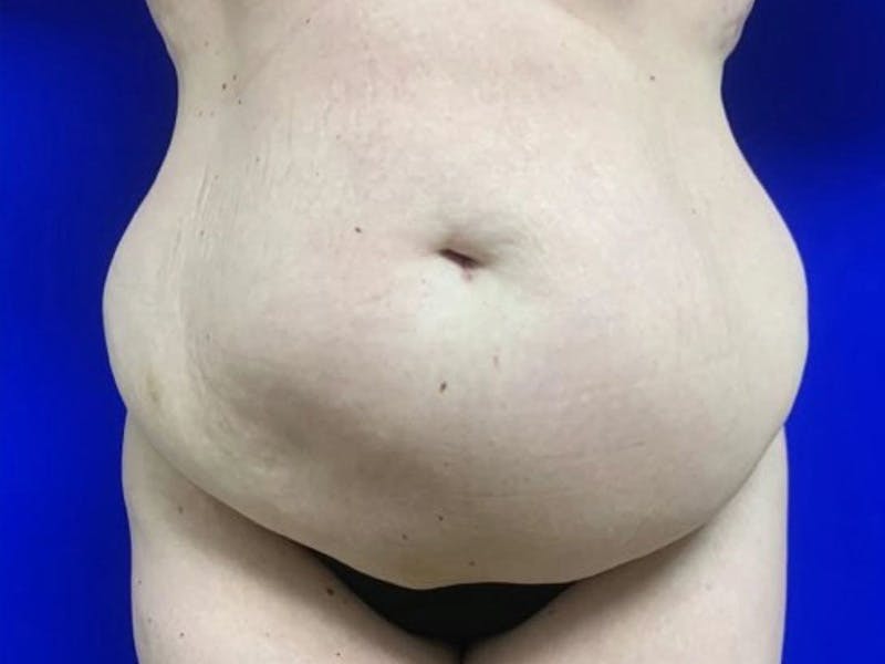 Tummy Tuck Before & After Gallery - Patient 404858 - Image 1