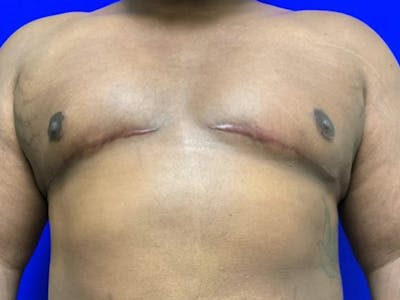 Gynecomastia Before & After Gallery - Patient 150764 - Image 2
