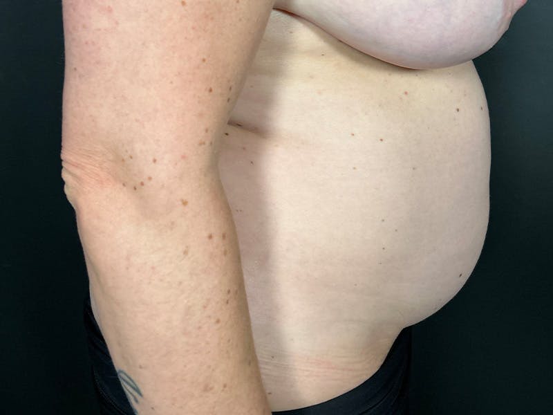 Abdomen Before & After Gallery - Patient 419008 - Image 5
