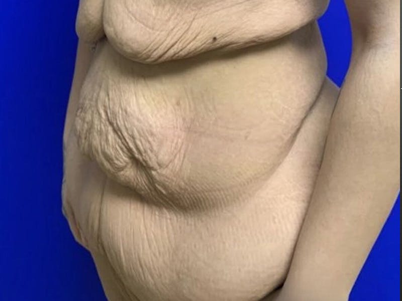 Tummy Tuck Before & After Gallery - Patient 102921 - Image 7