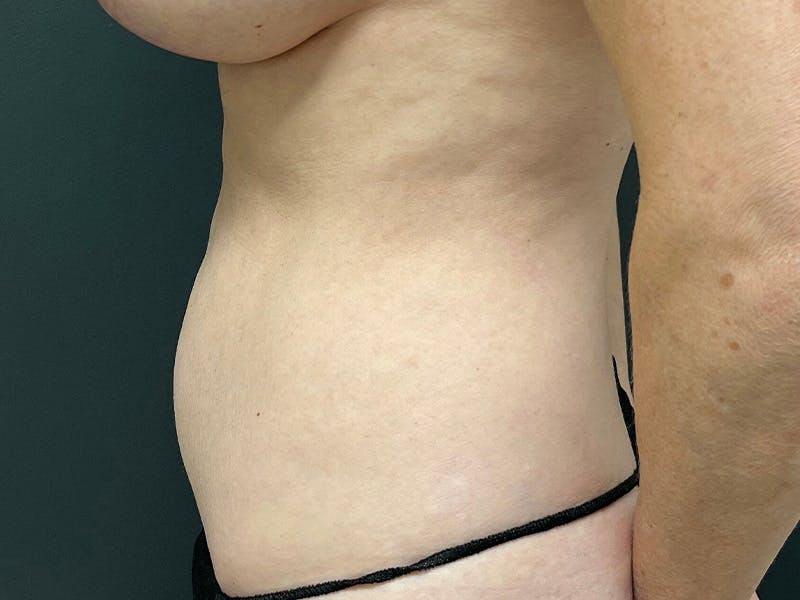 Mini Tummy Tuck Before & After Gallery - Patient 491163 - Image 9