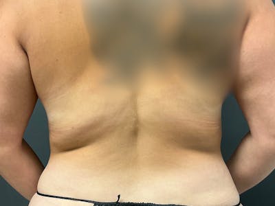 Back Before & After Gallery - Patient 377734 - Image 2