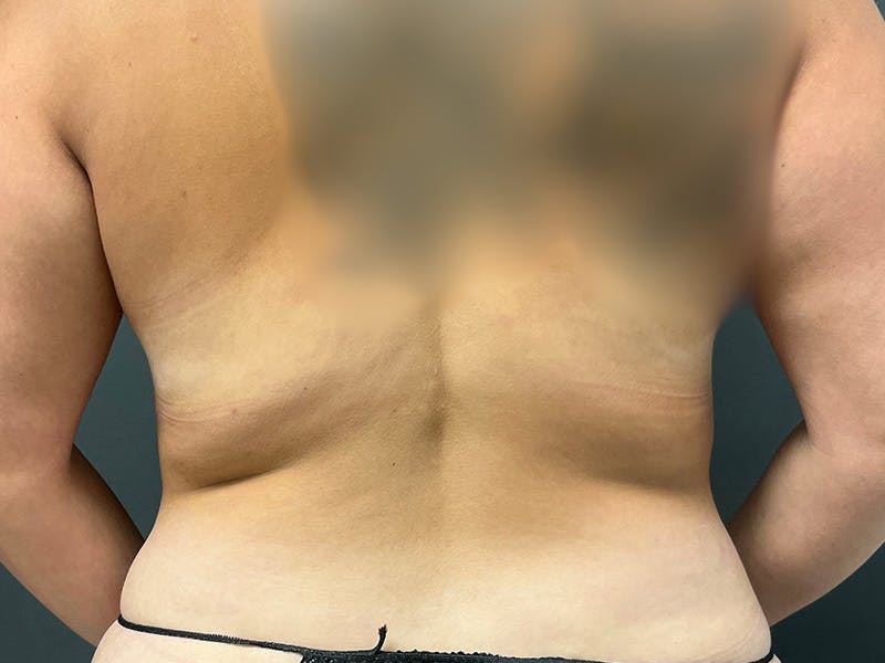 Back Before & After Gallery - Patient 377734 - Image 2