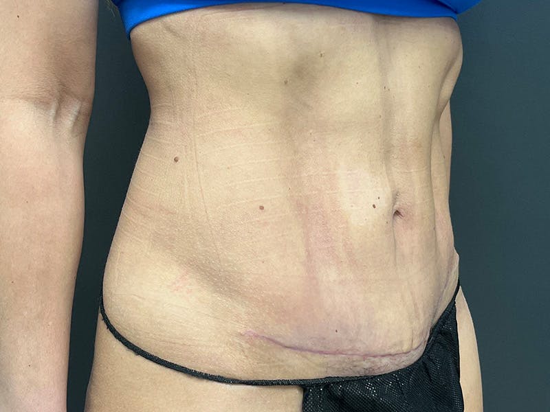 Abdomen Before & After Gallery - Patient 158442 - Image 4