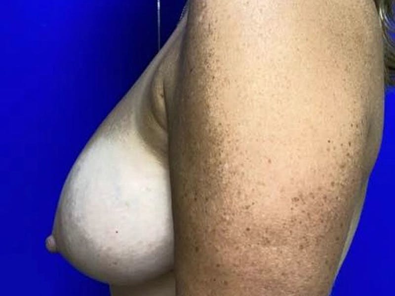 Breast Reduction Before & After Gallery - Patient 419400 - Image 7