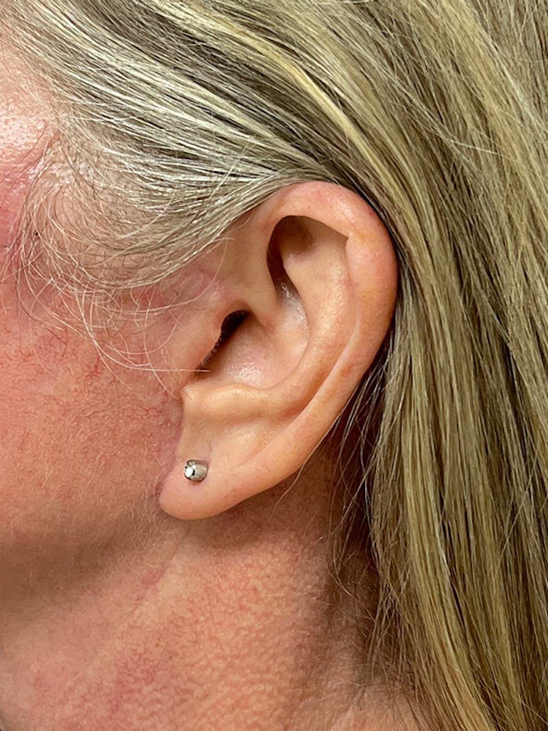Earlobe Repair Before & After Gallery - Patient 298992 - Image 10