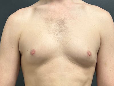 Gynecomastia Before & After Gallery - Patient 376405 - Image 1