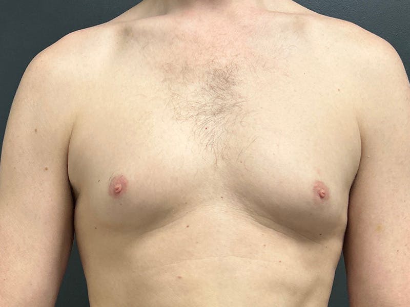 Gynecomastia Before & After Gallery - Patient 376405 - Image 1