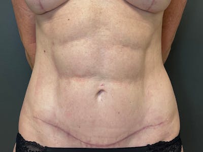 Mini Tummy Tuck Before & After Gallery - Patient 226626 - Image 2