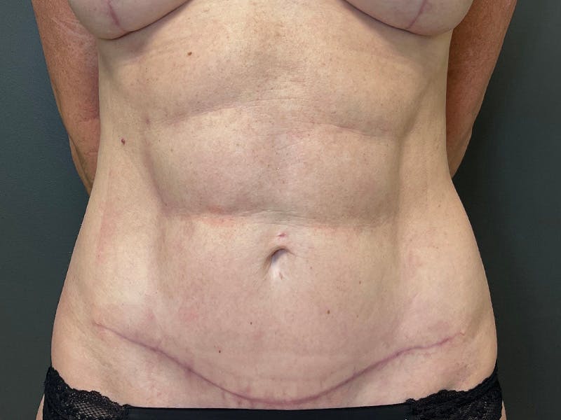 Mini Tummy Tuck Before & After Gallery - Patient 226626 - Image 2
