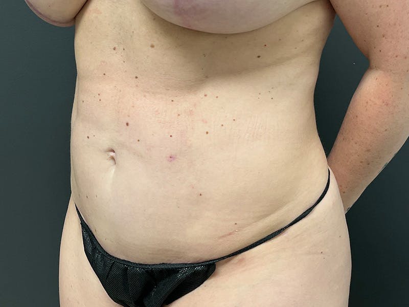 Mini Tummy Tuck Before & After Gallery - Patient 169656 - Image 8