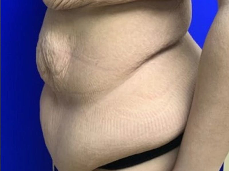 Tummy Tuck Before & After Gallery - Patient 102921 - Image 9