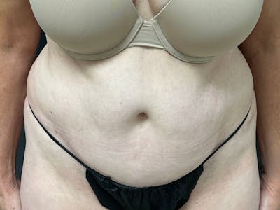Abdomen Before & After Gallery - Patient 784997 - Image 1
