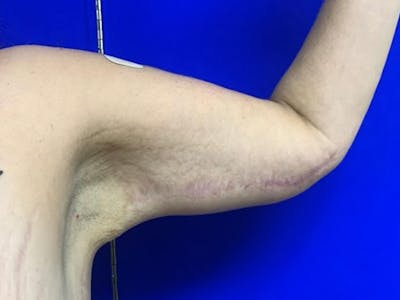 Arm Lift Before & After Gallery - Patient 256451 - Image 2