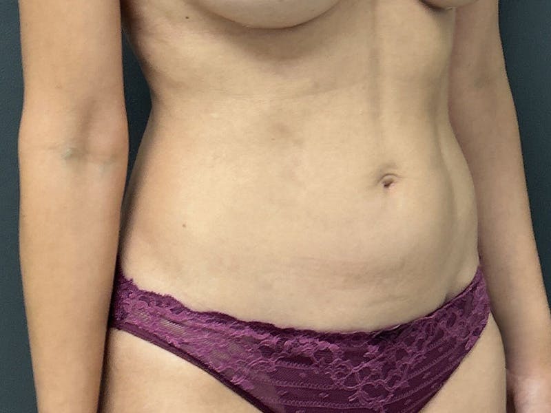 Abdomen Before & After Gallery - Patient 171479 - Image 4
