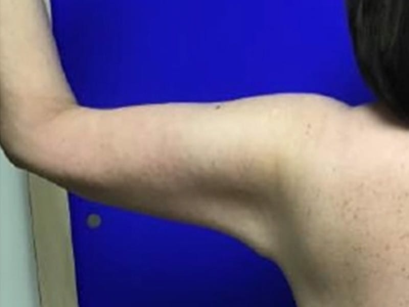 Arm Lift Before & After Gallery - Patient 256451 - Image 6