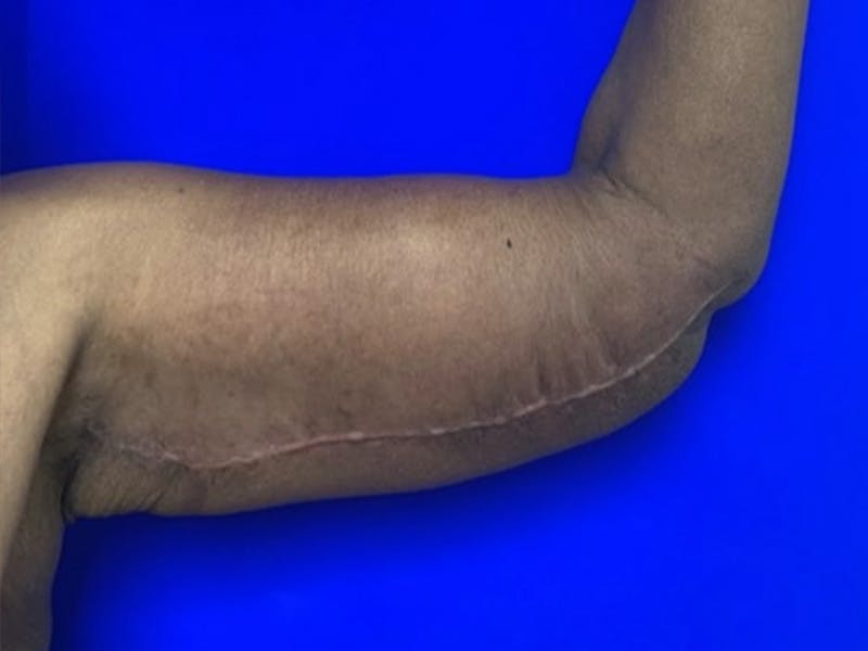 Arm Lift Before & After Gallery - Patient 122659 - Image 4