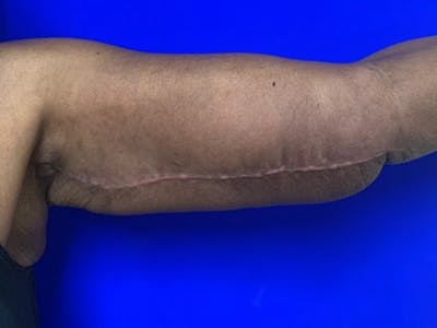 Arm Lift Before & After Gallery - Patient 122659 - Image 2