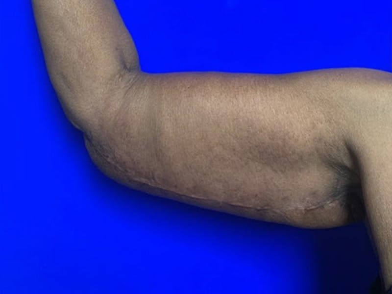 Arm Lift Before & After Gallery - Patient 122659 - Image 8